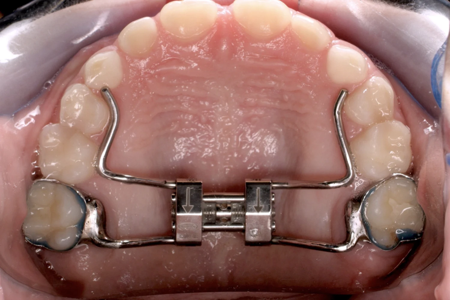 Orthodontic Expansion Appliances