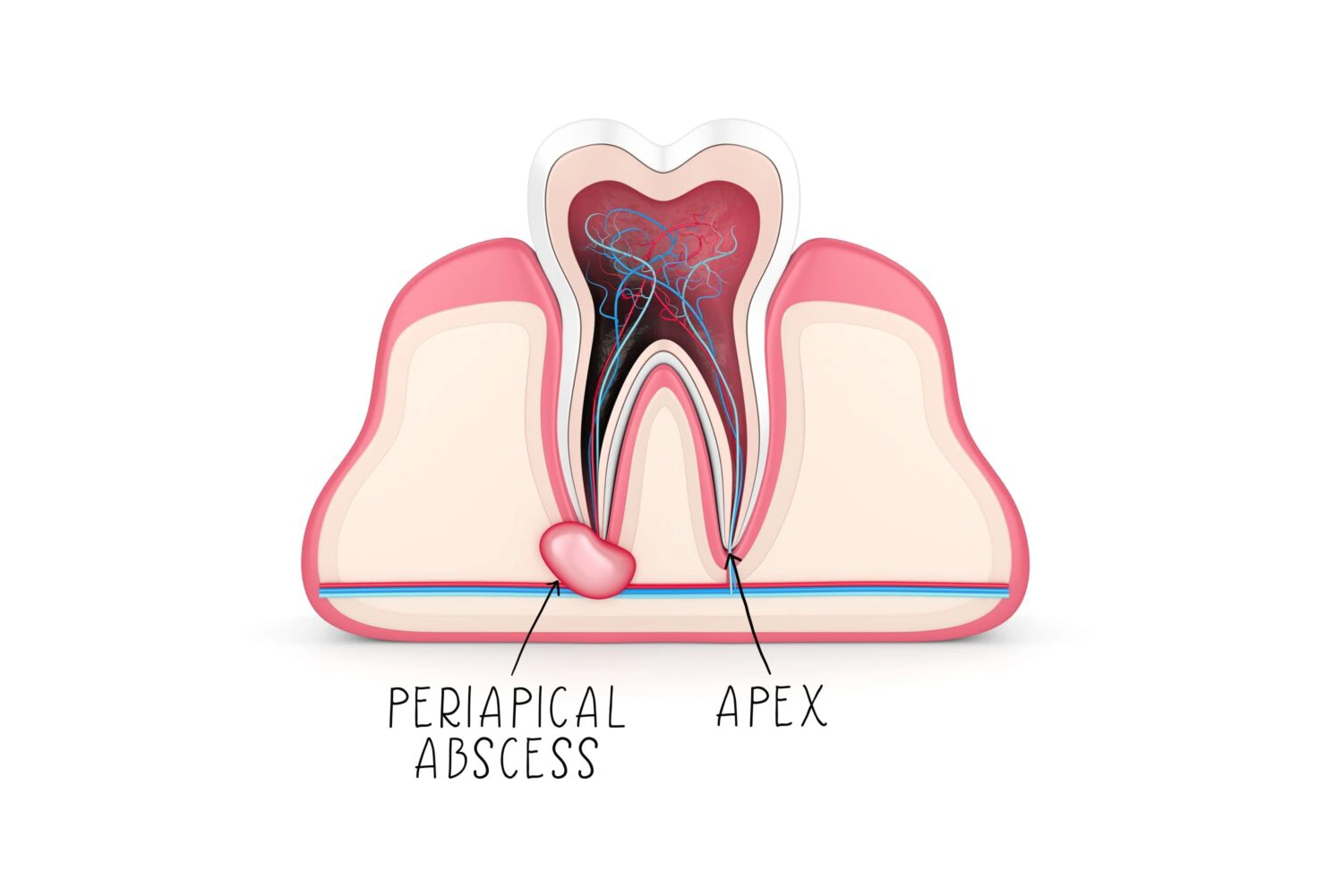 Periapical Abscess: What Causes It and How to Treat It