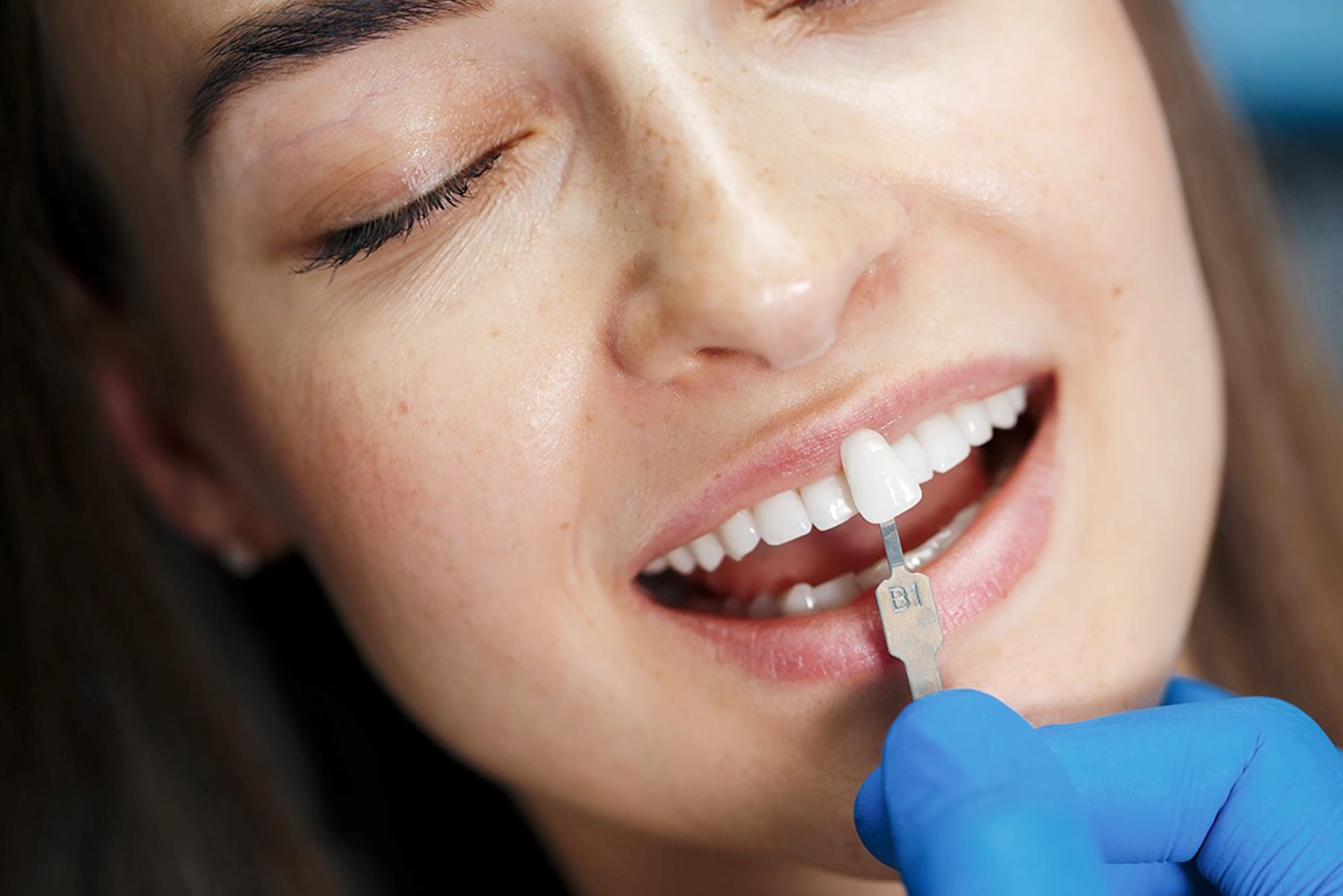 الحشوات التجميلية المركّبة مقابل حشوات السيراميك (Inlays): ما الفرق بينهما؟